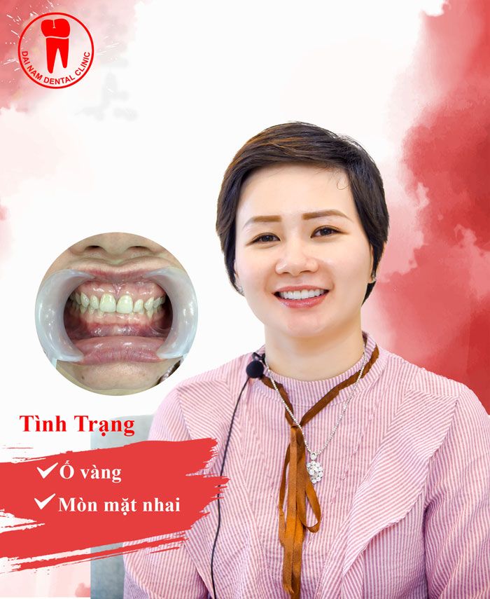Khách hàng làm răng sứ tại Nha khoa Sài Gòn