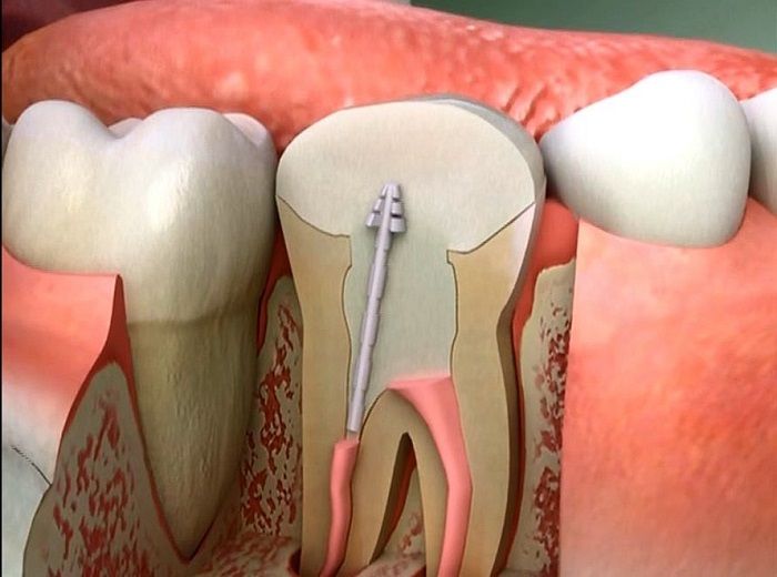 Răng đã lấy tủy thì còn tồn tại được bao lâu?
